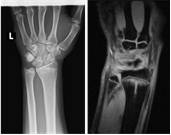 X線撮影では判別できなかった橈骨骨折例